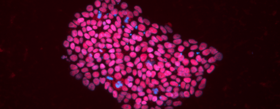 iPSC from an esophageal atresia patient - OCT4