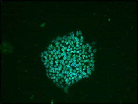 SOX2 iPSC from esophageal patient
